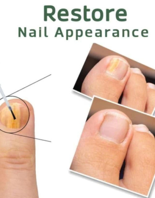 BeeVenom Nail Fungus Solution 15ml Each (Pack of 2)